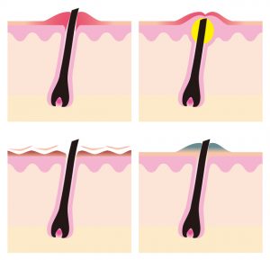 毛嚢炎と色素沈着