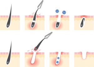 毛抜きによる毛嚢炎