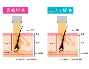 医療脱毛と脱毛サロン